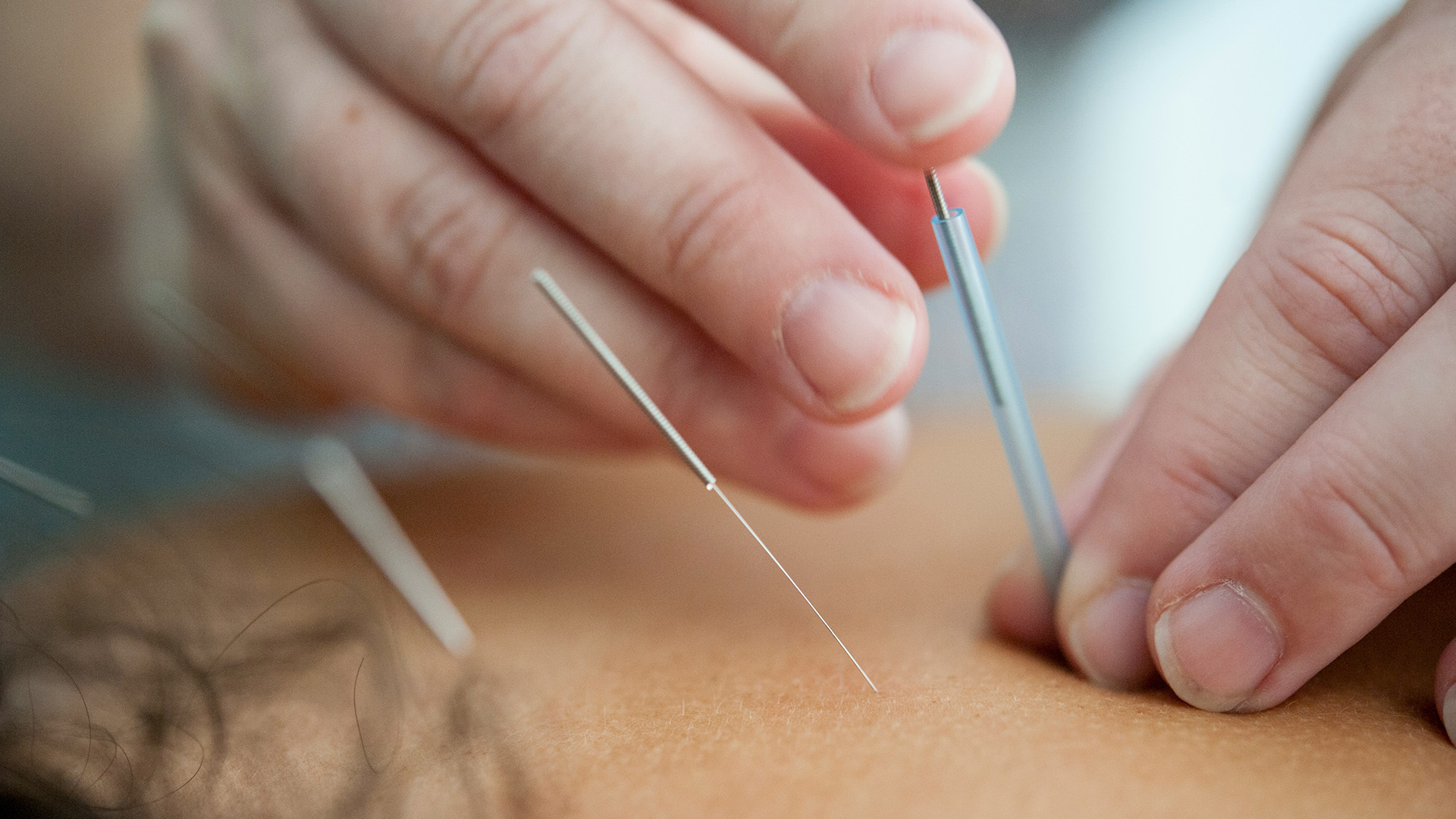 Acupuncture treatment on a back.