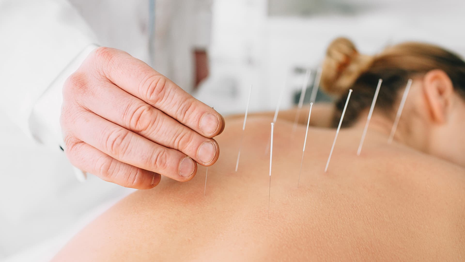 Transform Your Skin Naturally with Cosmetic Acupuncture