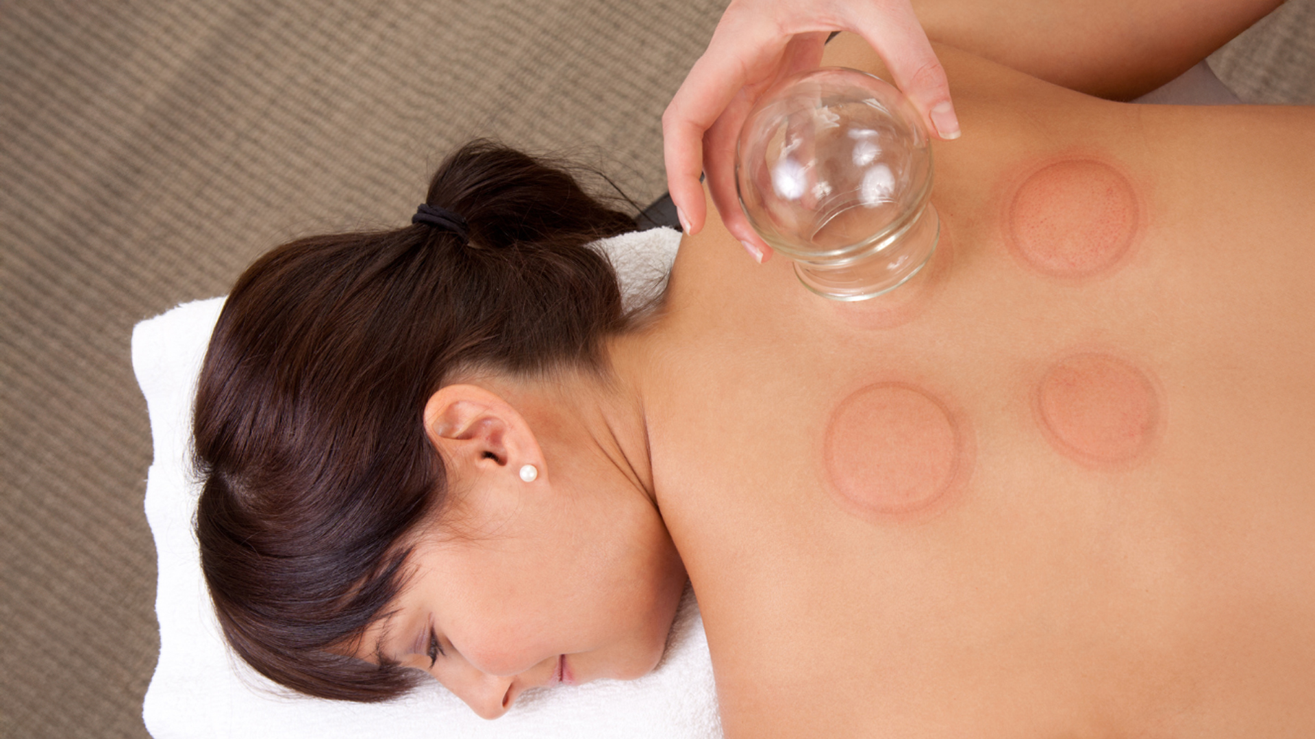 The Benefits of Cupping Therapy with Acupuncture in Coquitlam: Pain Relief and Relaxation